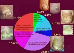 Грибок на ногтей лечение народными средствами в домашних условиях