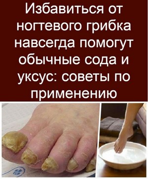 Грибок на коже у детей лечение