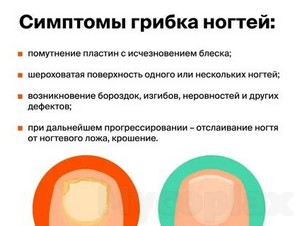 Лечение грибка ногтей на ногах в москве по омс