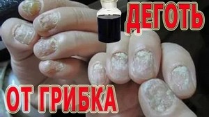 Гель лечения грибка ногтей