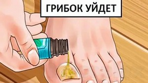 Грибок ногтей лечение нашатырным спиртом