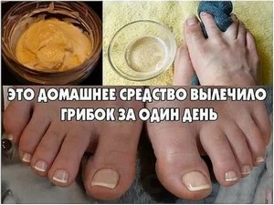 Лечение грибка ногтя у врача