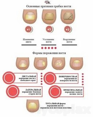 Лечение грибка ногтя мертвой водой