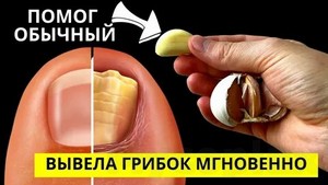 Грибок ногтей на ногах лечение быстро и эффективно народными средствами