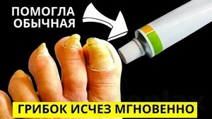 Народные средства для лечения ногтей от грибка ногтей