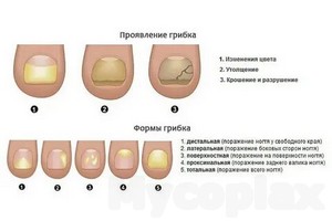 Лечение грибка ногтей на ногах в спб