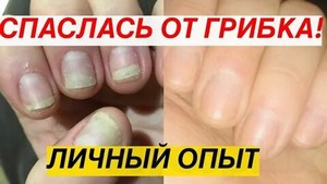 Грибок на ног лечение отзывы