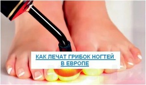 Лечение грибка ногтя ноги народными