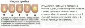 Лечение грибка ногтей на ногах лазером в москве отзывы цена