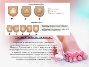 Новые методы лечения грибка ногтей на ногах