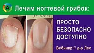 Лазерное лечение грибка ногтей в череповце