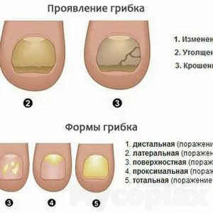 Эффективное средство при лечении грибка ногтей на ногах