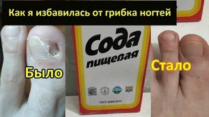 Пластырь на ногти для лечения грибка ногтей