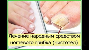 Грибок на ногах фото лечение народными средствами