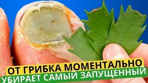 Лечение лазером грибка в челябинске