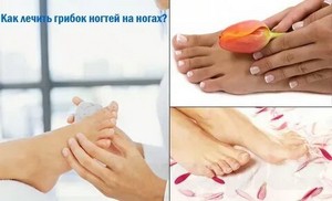 Эффективное лечение грибка ногтей на ногах таблетками