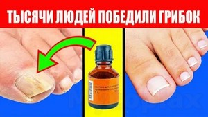 Грибок в ушах ребенка лечение