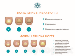 От грибка кожи головы лечение