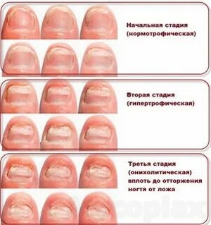 Грибок ногтя на ногах лечение препараты недорогие но эффективные отзывы