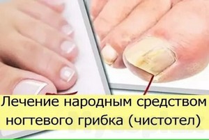 Грибок ногтей внутреннее лечение