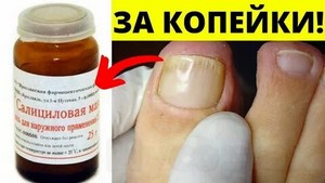 Комплексное лечение грибка ногтя ноги