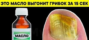 Йодинол для лечения грибка ногтей