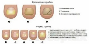 Грибок ногтей лечение препараты недорогие но эффективные