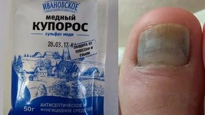 Подолог лечение грибка москва