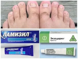 Микоз грибок лечение