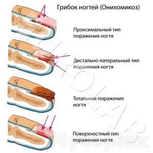 Итраконазол при грибке ногтей лечение