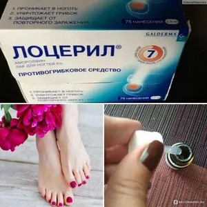 Лечение грибка фотодинамической терапией отзывы